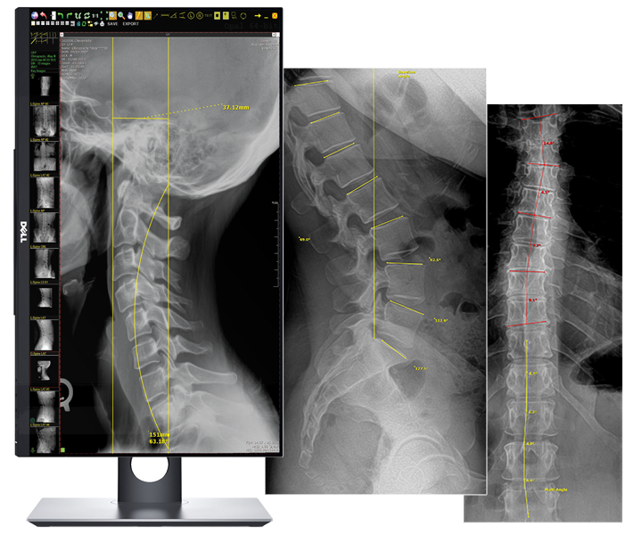 Digital X-ray analysis: a monitor displaying a cervical X-ray with measurement lines, beside lumbar and full-spine films marked with angles